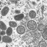NYC Monkeypox Update: 2 More Presumed Cases Identified
