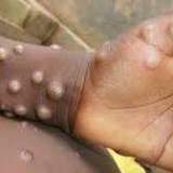 WHO says coordinating with UK over monkeypox outbreak