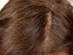 قشرة الشعر 2013 , اسباب قشرة الشعر و علاجها 2013 images?q=tbn:ANd9GcSQEk_d4V-Vun4rOGAArUoMgJjTlJF1CtkD4pEORUWy2-VZcZyk