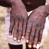 Dramatic spike in monkeypox cases leads to CDC launching new emergency center with US infections now at 306