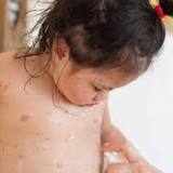 Why is chickenpox called chickenpox? The infection's name explained and why you can't catch it fro
