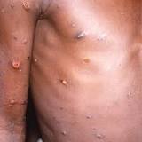 Monkeypox outbreak growing across Britain