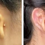 Cornellian-founded company implants 3D-bioprinted ear