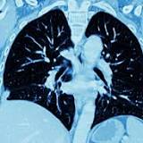 British health officials recommend everyone over the age of 55 be screened for lung cancer