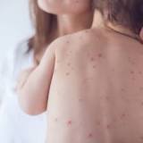 Scarlet fever symptoms: Parents urged to check for warning signs as cases rise