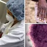 Monkeypox Quarantine: Belgium Becomes 1st Country to Introduce Compulsory Isolation Measures in View of Rising ...
