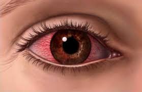 جفاف العين يهاجم النساء أكثر