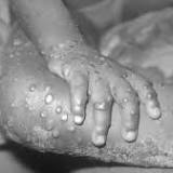 What is monkeypox, the rare disease now confirmed in Massachusetts?