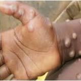 New York Declares State Emergency as Monkeypox Infections Spread