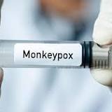 Local Transmission of Monkeypox Found In Los Angeles County
