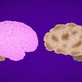 Can Alzheimer's begin in 20s? Here are signs of early onset Alzheimer's disease