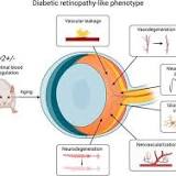 Uncovering the Key Process That Contributes to Vision Loss and Blindness in People With Diabetes