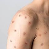 Luxembourg has recorded 8 cases of monkeypox